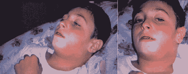 a picture of a white kid with diptheria